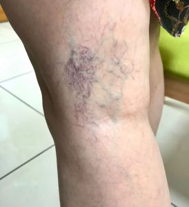 【四院|科普】腿上爬满的“红血丝”原来一招就可以解决